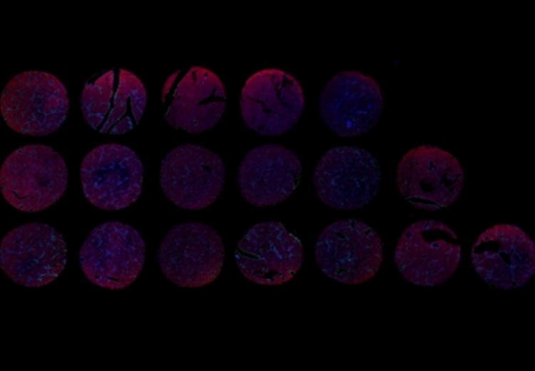 组织芯片扫描（荧光双标 三色）(图1)