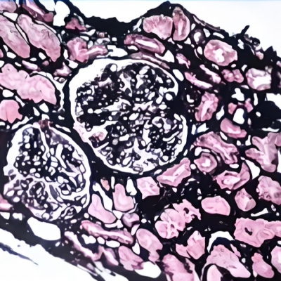 六胺银染色（神经内分泌细胞）