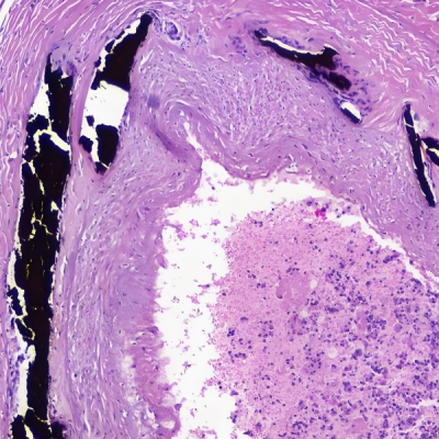 Vonkossa染色(钙化)